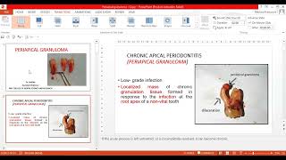 Periapical Granuloma [upl. by Noiemad528]