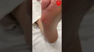 Small Forefoot Callus [upl. by Stringer]