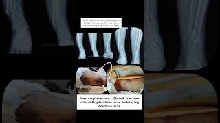 Ankle fracture surgery  distal tibia intraarticular fracture management legfracture orthoedge [upl. by Culver]