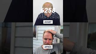 Résultat de la greffe de cheveux à HAUTE DENSITÉ  2000 greffons avant et après [upl. by Hardin]