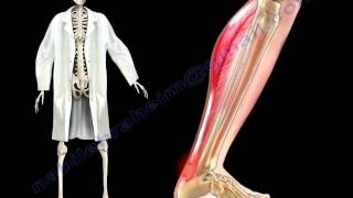 Achilles Tendon Stress amp Strain  Everything You Need To Know  Dr Nabil Ebraheim [upl. by Pippa]