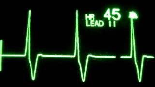 Accelerated Ventricular Rhythm AVR [upl. by Acemahs]