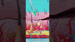 How Subcutaneous Injection Works [upl. by Aicrag780]