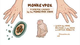 Monkeypox Explained [upl. by Lebazej]