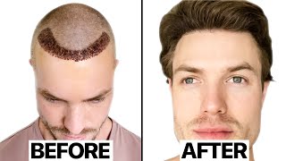 My Hair Transplant Results 6 Months  Surgeon Reacts [upl. by Nauqyaj522]