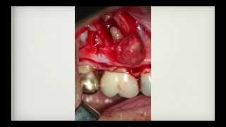 Actinomycosis of the Jaw Nasseh Case report amp Interview with Dr Eleni Gagari [upl. by Harmony838]