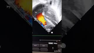 Neonate with hypoxic respiratory failure ECHO evidences [upl. by Tnomal]