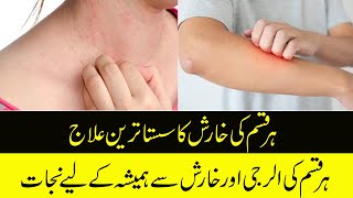 Kharish ka Fori ilaj  Kharish ko khatam Karnyk Tariqa  Karis ka Fori Elaj  Desi Elaj For Skin [upl. by Agee]