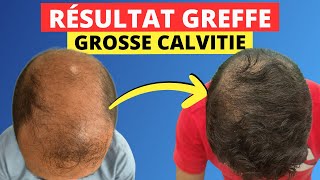 Greffe de cheveux et Calvitie Enorme  Ça vaut le coup La réponse en image 📹 [upl. by Sweatt]