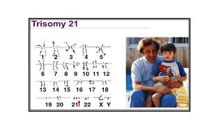 Chromosomal abnormalities Video No 498 [upl. by Chema4]