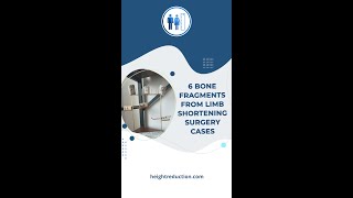 6 bone fragments from limb shortening surgery cases [upl. by Clellan]