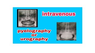 Intravenous Pyelography  Urography IVP  IVU [upl. by Bender]