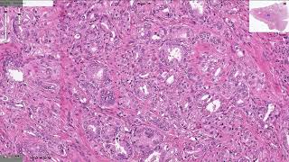 Prostatic Adenocarcinoma  Histopathology [upl. by Wehrle]