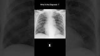 Miliary TB 119 chest Xray Quiz pulmonary disease radiologychannel007 [upl. by Whallon]