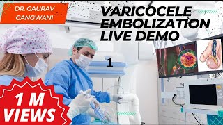 Live Varicocele Embolization Case 1 Nonsurgical treatment of Varicocele  Dr Gaurav Gangwani [upl. by Alroi]