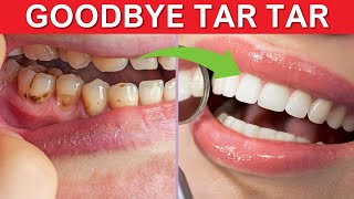 Eliminate Tartar Naturally Homemade Remedies to Remove Plaque amp Tartar Fast [upl. by Faustus]