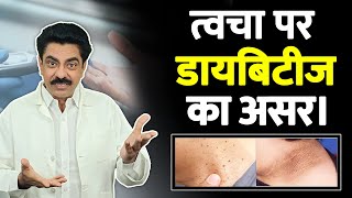 Common skin problems in diabetes  Skin Tags  Diabetes Sign amp Symptoms  Longlivelives Hindi [upl. by Naghem]