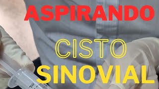 Aspirando um Cisto Sinovial [upl. by Reggie330]