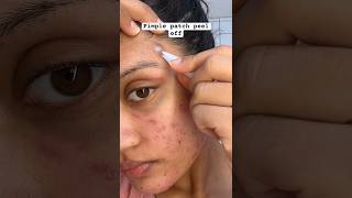 Pimple Patch Removal😱 acne pimplepatch pimplepatches acnepatch acnes acneproneskin pimplepop [upl. by Nhepets]