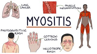 Understanding Myositis Polymyositis and Dermatomyositis [upl. by Hefter]