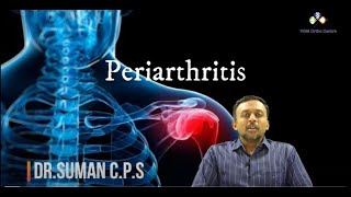 What is PERIARTHRITIS – SHOULDER PAIN What are its Remedies  by DrSuman CPS VGM Hospital [upl. by Luapleahcim]