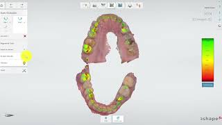 TRIOS 3shape occlusion settings flag adjust for contacts [upl. by Aicile]