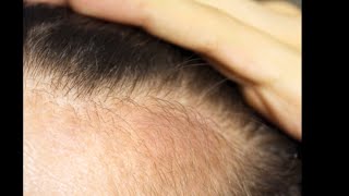 Regrow hair 100 and Stop hair fall Stop hair grey with simple tips [upl. by Bradney750]