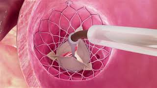 Transcatheter Aortic Valve Replacement [upl. by Aridnere556]