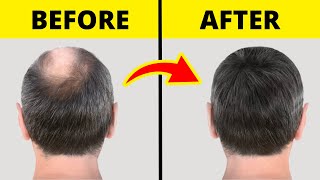 10 Guaranteed Ways to Regrow Hair Fast  🚫 No Surgery [upl. by Assiled]