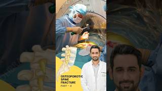 Treatment of Osteoporotic spine fracture  Dr Dheeraj Batheja  Part 2 doctor spinehealth [upl. by Nepets]