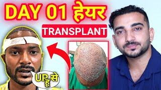 Day 01 Hair Transplant  Day One Hair Transplant Surgery  Beginning Hair Transplant [upl. by Sawtelle819]