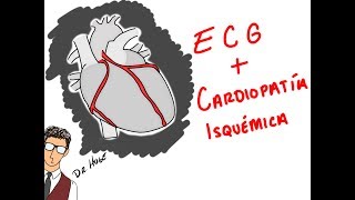 INFARTOS Y ECG COMO NADIE TE LO HA EXPLICADO [upl. by Ocirled]