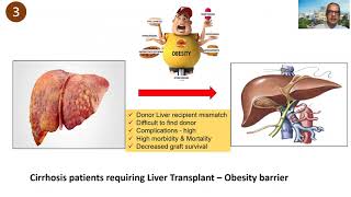 Bariatric Surgery in patients with Cirrhosis Dr H V Shivaram [upl. by Malkin]