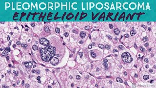 Pleomorphic Liposarcoma Epithelioid Variant [upl. by Ahsauqal]