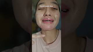 Hiperplasia Sebasea Treatment di Klinik Kecantikan Surabaya [upl. by Lletnom]