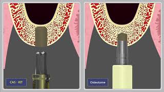 CAS KIT Drill vs Osteotome Comparison [upl. by Hett]