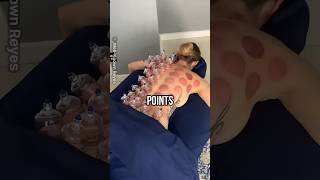 Cupping Therapy for Fatigue Recovery [upl. by Edaj]