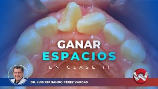 Como crear espacios SIN EXTRACCIONES dentales en una clase II esquelética [upl. by Goulette]