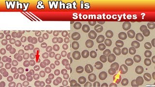 What is Stomatocytes   Clear Explain [upl. by Richardson]