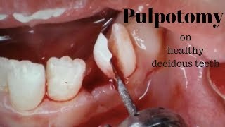 Pulpotomy on healthy Deciduous teeth [upl. by Flaherty]