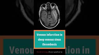 Venous infarction in deep venous sinus thrombosis  Radiology tutorials  video 56 [upl. by Naanac]