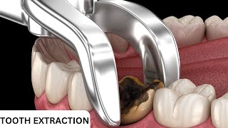 Things You Dont Know About Tooth Extraction [upl. by Akcirret]