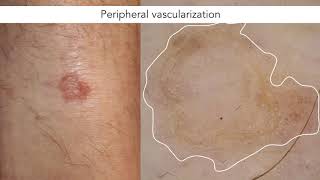 Dermoscopic features of porokeratosis  Dr John Paoli [upl. by Ttej446]