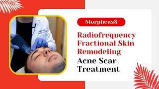 Morpheus8  Radiofrequency Fractional Skin Remodeling  Acne Scar Treatment  Jason Emer MD [upl. by Consuelo173]