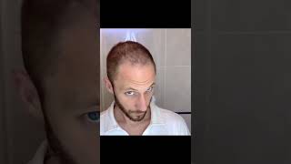 How I Use DermaRoller for Hair Growth To Solve my Baldness and Hair Loss Tutorial How To [upl. by Groot411]