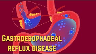 Gastroesophageal Reflux Disease GERD  CRASH Medical Review Series [upl. by Palua227]