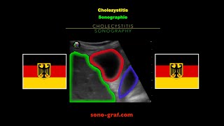 Sonographie  Cholezystitis [upl. by Fagan]