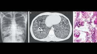 Pulmonale alveoläre Microlithiasis kompliziert durch Tuberkulose [upl. by Asillim]