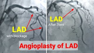 Angioplasty ll Angioplasty procedureRadial access Stenting of LAD हार्ट मैं छल्ला कैसे लगाते है [upl. by Meris]