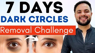 7 Days Dark Circles Removal Challenge  Permanent Treatment [upl. by Ellek]